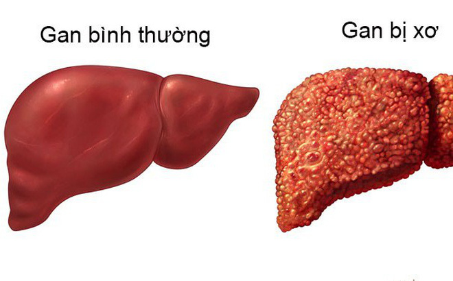 Bệnh xơ gan
